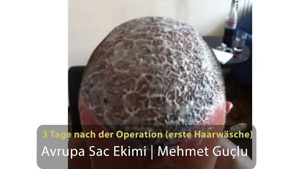 Foto von Avrupa Sac Ekimi - Haartransplantation