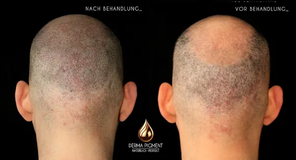 Foto von Derma Pigment – Haarpigmentierung München | Natürlich Perfekt