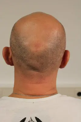 Foto von Dothair - Kopfhaarpigmentierung in Düsseldorf