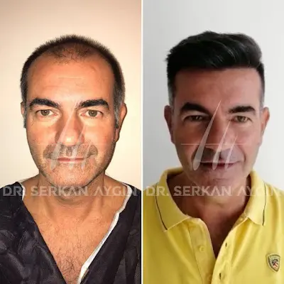 Dr. Serkan Aygin | Haartransplantation in der Türkei | Beratungsstelle Deutschland