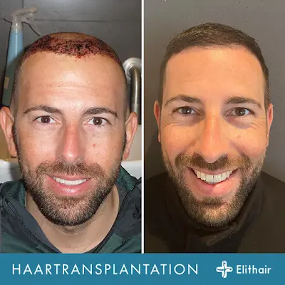 Foto von Elithair - PRP-Behandlung Düsseldorf, Haartransplantation