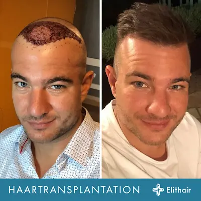 Foto von Elithair - PRP Behandlung Stuttgart I Haartransplantation