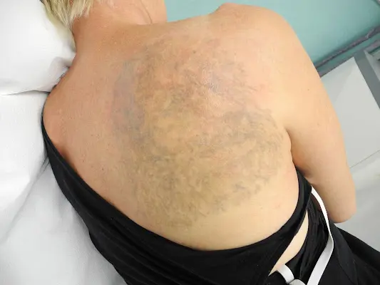 ENDLICH OHNE Tattooentfernung Filiale Hannover