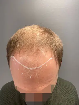 Foto von First Hair Clinic - Haartransplantation Deutschland