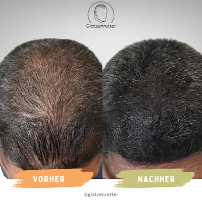 Foto von Glatzenretter Haarpigmentierung (SMP) Bremen