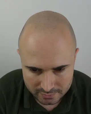 Foto von Haarexperten für Haarpigmentierung und Haartransplantation