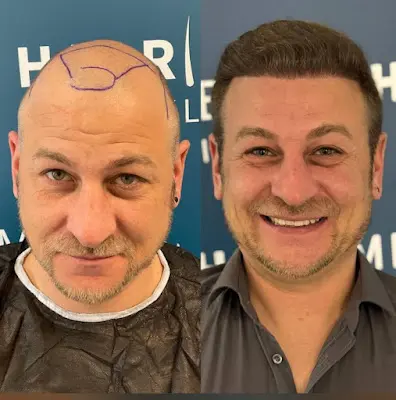 Haarmed Haartransplantation