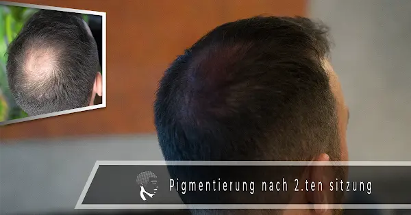 Foto von Haarpigmentierung Berlin | OpticHair