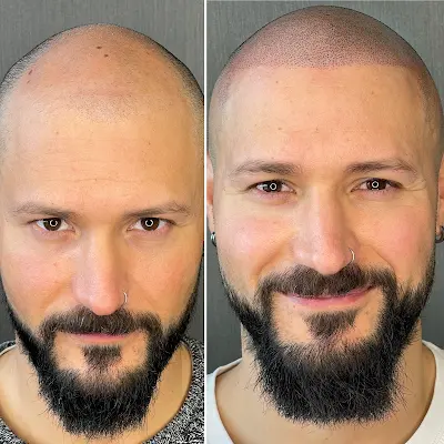 Foto von Haarpigmentierung Stuttgart - Propigments