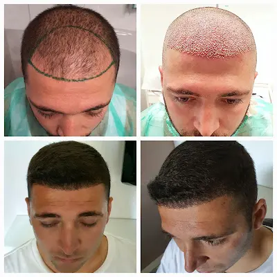 Foto von Haartransplantationszentrum - Stuttgart