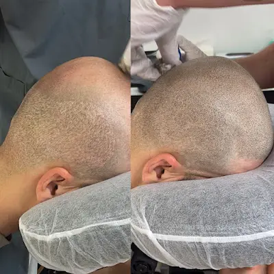 Foto von Happy Scalps® | Haarpigmentierung