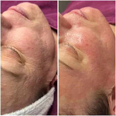 Kosmetikinstitut Anja Taute - Bernburg - Kosmetikmeisterin - Dauerhafte Haarentfernung - Microneedling - Microdermabrasion