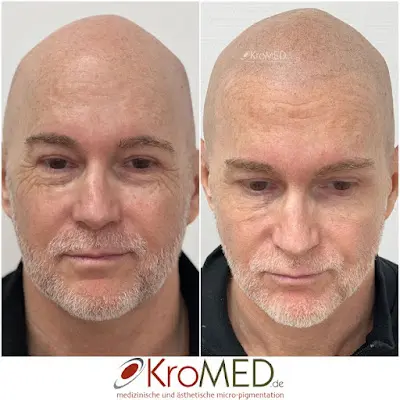 Foto von KroMED | medizinisch ästhetische micro Pigmentierung | Hamburg