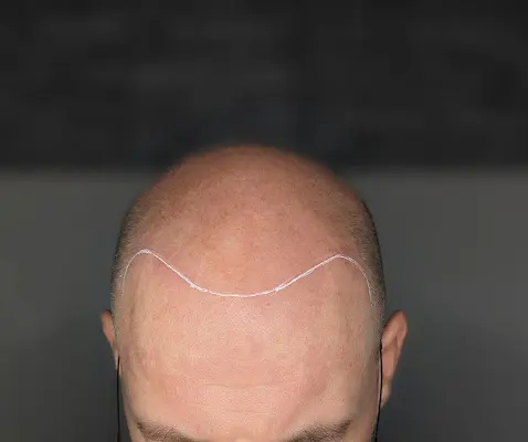 Foto von Lion Haarpigmentierung -Kopfhautpigmentierung