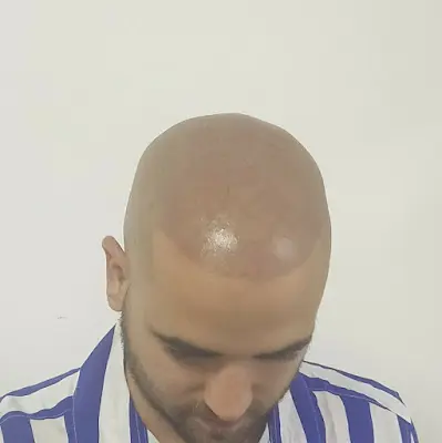 Foto von Natural Pigment Hair Haarpigmentierung Nano Haarpigmentierung