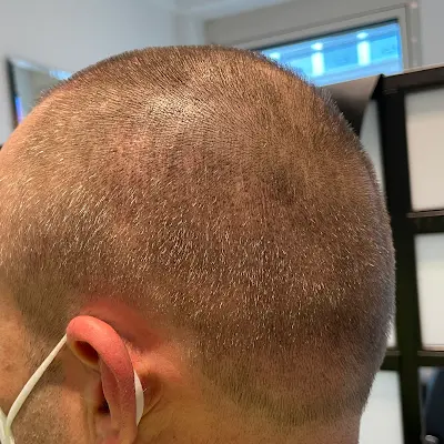 Foto von Neues Transpla Haar