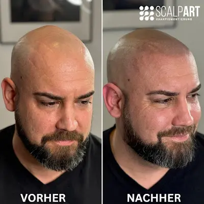 Foto von Scalp Art Haarpigmentierung