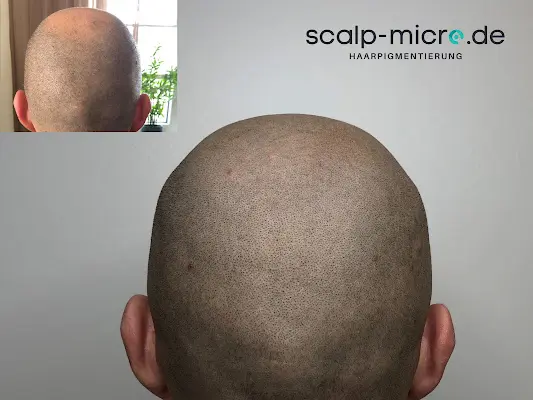 Foto von scalp-micro.de | Haarpigmentierung
