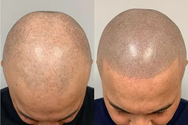 Foto von Scalp Time Haarpigmentierung