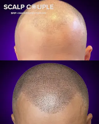 Foto von SCALPCOUPLE | HAARPIGMENTIERUNG | SMP