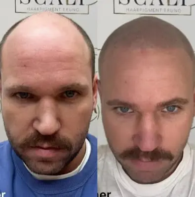 Foto von ScalpEr Haarpigmentierung