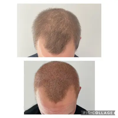 Foto von SimplyHair - Haarpigmentierung Heidelberg