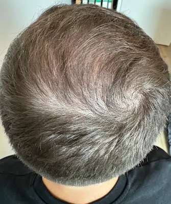 Unique Hair Hamburg | Haartransplantation | PRP Behandlung